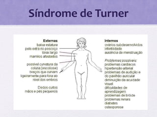Síndrome de Turner
 