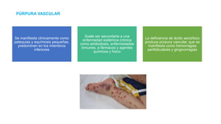 PÚRPURA VASCULAR
Se manifiesta clínicamente como
petequias y equímosis pequeñas,
predominan en los miembros
inferiores
Suele ser secundaria a una
enfermedad sistémica crónica
como amiloidosis, enfermedades
inmunes, a fármacos y agentes
químicos y físico
La deficiencia de ácido ascórbico
produce púrpura vascular, que se
manifiesta como hemorragias
perifoliculares y gingivorragias
 