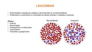 LEUCEMIAS
• Enfermedades neoplásicas malignas más frecuentes en la edad pediátrica
• Proliferación y crecimiento no controlado de células linfoides o mieloides inmaduras
Clínica
• Anemia
• Hemorragias
• Predisposición a infecciones
• Crecimientos
• Viscerales y ganglionares
 
