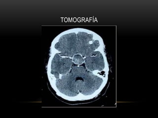 TOMOGRAFÍA 
 