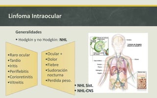 Linfoma Intraocular
Generalidades
 Hodgkin y no Hodgkin: NHL
•Raro ocular
•Tardío
•Iritis
•Periflebitis
•Corioretinitis
•Vitreitis
•Ocular +
•Dolor
•Fiebre
•Sudoración
nocturna
•Perdida peso.
 NHL Sist.
 NHL-CNS
 