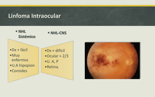 Linfoma Intraocular
•Dx + fácil
•Muy
enfermos
•U.A hipopion
•Coroides
•Dx + difícil
•Ocular + 2/3
•U. A, P
•Retina.
 NHL
Sistémico
 NHL-CNS
 