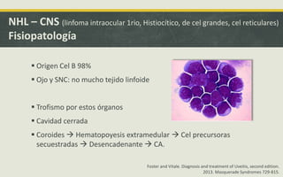 NHL – CNS (linfoma intraocular 1rio, Histiocítico, de cel grandes, cel reticulares)
Fisiopatología
 Origen Cel B 98%
 Ojo y SNC: no mucho tejido linfoide
 Trofismo por estos órganos
 Cavidad cerrada
 Coroides  Hematopoyesis extramedular  Cel precursoras
secuestradas  Desencadenante  CA.
Foster and Vitale. Diagnosis and treatment of Uveitis, second edition.
2013. Masquerade Syndromes 729-815.
 