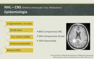 NHL – CNS (linfoma intraocular 1rio, Histiocítico)
Epidemiología
 80% Compromiso SNC
 50% Compromiso Ocular
 10% Diseminada
♂ ligeramente, no razas
50-60 años
51 x 10mill (2000)
Inmunosupresión
Bilateral 80%
Tsai and O’Brien. Masquerade Syndromes: Malignancies Mimicking
Inflammation in the Eye.Int Ophthalmol Cl. 2002 ;42(1):115-31.
 