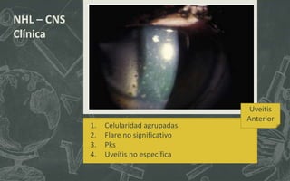 1. Celularidad agrupadas
2. Flare no significativo
3. Pks
4. Uveítis no específica
NHL – CNS
Clínica
Uveitis
Anterior
 