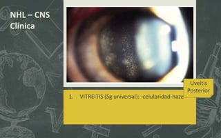 1. VITREITIS (Sg universal): -celularidad-haze
NHL – CNS
Clínica
Uveítis
Posterior
 