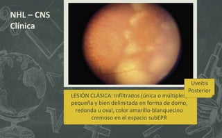 LESIÓN CLÁSICA: Infiltrados (única o múltiples)
pequeña y bien delimitada en forma de domo,
redonda u oval, color amarillo-blanquecino
cremoso en el espacio subEPR
NHL – CNS
Clínica
Uveítis
Posterior
 