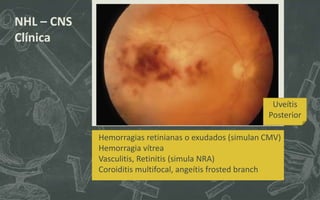NHL – CNS
Clínica
Uveítis
Posterior
Hemorragias retinianas o exudados (simulan CMV)
Hemorragia vítrea
Vasculitis, Retinitis (simula NRA)
Coroiditis multifocal, angeítis frosted branch
 