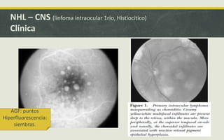 NHL – CNS (linfoma intraocular 1rio, Histiocítico)
Clínica
AGF: puntos
Hiperfluorescencia:
siembras.
 