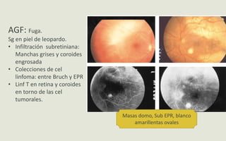Masas domo, Sub EPR, blanco
amarillentas ovales
AGF: Fuga.
Sg en piel de leopardo.
• Infiltración subretiniana:
Manchas grises y coroides
engrosada
• Colecciones de cel
linfoma: entre Bruch y EPR
• Linf T en retina y coroides
en torno de las cel
tumorales.
 