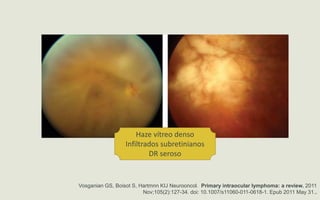 Haze vítreo denso
Infiltrados subretinianos
DR seroso
Vosganian GS, Boisot S, Hartmnn KIJ Neurooncol. Primary intraocular lymphoma: a review. 2011
Nov;105(2):127-34. doi: 10.1007/s11060-011-0618-1. Epub 2011 May 31..
 
