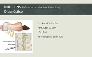 6. Punción lumbar:
 PIC Alta: 15-60%
 5-10ml
 Será positiva en el 42%
NHL – CNS (linfoma intraocular 1rio, Histiocítico)
Diagnóstico
 