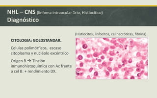 CITOLOGIA: GOLDSTANDAR.
Celulas polimórficos, escaso
citoplasma y nucléolo excéntrico
Origen B  Tinción
inmunohistoquimica con Ac frente
a cel B: + rendimiento DX.
NHL – CNS (linfoma intraocular 1rio, Histiocítico)
Diagnóstico
(Histiocitos, linfocitos, cel necróticas, fibrina)
 