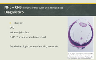 8. Biopsia:
SNC
Nódulos (si aplica)
OJOS: Transescleral o transretinal
Estudio Patología por enucleación, necropsia.
NHL – CNS (linfoma intraocular 1rio, Histiocítico)
Diagnóstico
 