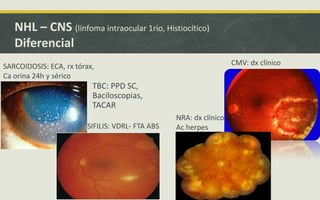 TBC: PPD SC,
Baciloscopias,
TACAR
NHL – CNS (linfoma intraocular 1rio, Histiocítico)
Diferencial
SARCOIDOSIS: ECA, rx tórax,
Ca orina 24h y sérico
SIFILIS: VDRL- FTA ABS
CMV: dx clínico
NRA: dx clínico,
Ac herpes
 