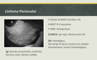 Linfoma Periocular
 Células B (MALT, Burkitt, LH)
 MALT Conjuntiva
 1996: Hoang-Xuan
CLINICA: ojo rojo, disminución AV.
DX: Histológica.
DX tempr local y buena rta a Radio.
Asociaciones: tumor hematológico.
Sg: Simula conjuntivitis, escleritis
Parches color salmón solidas
 