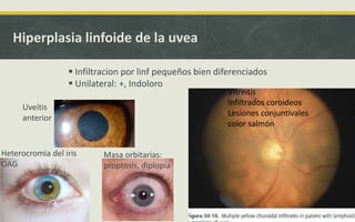 Hiperplasia linfoide de la uvea
 Infiltracion por linf pequeños bien diferenciados
 Unilateral: +, Indoloro
Masa orbitarias:
proptosis, diplopía
Heterocromia del iris
OAG
Uveítis
anterior
Vitreitis
Infiltrados coroideos
Lesiones conjuntivales
color salmón
 