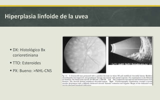 Hiperplasia linfoide de la uvea
 DX: Histológico Bx
corioretiniana
 TTO: Esteroides
 PX: Bueno: >NHL-CNS
 