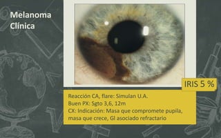 Melanoma
Clínica
IRIS 5 %
Reacción CA, flare: Simulan U.A.
Buen PX: Sgto 3,6, 12m
CX: Indicación: Masa que compromete pupila,
masa que crece, Gl asociado refractario
 