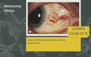 Melanoma
Clínica
CUERPO
CILIAR 10 %
Vasos centinela epiesclerales: simula
epiescleritis
 