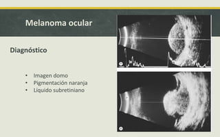 Melanoma ocular
Diagnóstico
• Imagen domo
• Pigmentación naranja
• Líquido subretiniano
 