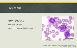 Leucemia
 LMA y LMCronica
 Ocular: 28-75%
 CA ↑↑Celularidad - hipopion
Korfel A, Thiel E, Nikolaos E. et al. Masquerade Syndrome. Dtsch
Arztebl 2007; 104(8): A 490–5.
 