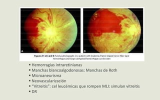  Hemorragias intraretinianas
 Manchas blancoalgodonosas: Manchas de Roth
 Microaneurisma
 Neovascularización
 “Vitreitis”: cel leucémicas que rompen MLI: simulan vitreitis
 DR
 