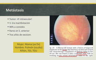 Metástasis
 Tumor +fr intraocular!
 ½ 1ra manifestación
 90% a coroides
 Raros en S. anterior
 Tras años de excision.
Mujer: Mama (ya Dx)
Hombre: Pulmón (oculto)
Riñón, TGI, TGU
 