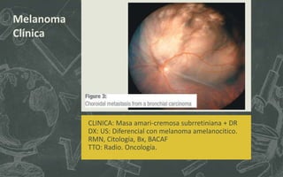 Melanoma
Clínica
CLINICA: Masa amari-cremosa subrretiniana + DR
DX: US: Diferencial con melanoma amelanocitico.
RMN, Citología, Bx, BACAF
TTO: Radio. Oncología.
 