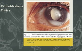 LEUCOCORIA, ESTRABISMO, DISMINUCION AV,
UVEITIS
Retinoblastoma
Clínica
 