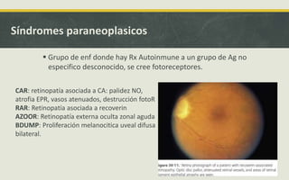 Síndromes paraneoplasicos
 Grupo de enf donde hay Rx Autoinmune a un grupo de Ag no
especifico desconocido, se cree fotoreceptores.
CAR: retinopatía asociada a CA: palidez NO,
atrofia EPR, vasos atenuados, destrucción fotoR
RAR: Retinopatía asociada a recoverin
AZOOR: Retinopatía externa oculta zonal aguda
BDUMP: Proliferación melanocitica uveal difusa
bilateral.
 