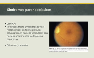 Síndromes paraneoplasicos
 CLINICA:
 Infiltrados tracto uveal difusos y cel
melanociticas en forma de huso,
algunas tienen núcleos vesiculares con
núcleos prominentes y citoplasma
espumoso
 DR seroso, cataratas
 