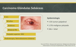 Carcinoma Glándulas Sebáceas
Epidemiología
 <1% tumor palpebral
 1-5% malignos párpado
 2do + letal
♀ 2:1
60 años
Asiáticos
Bilateral 9%
Parpado superior: RR2
Radioterapia, Retinoblastoma bilateral
Tsai and O’Brien. Masquerade Syndromes: Malignancies Mimicking
Inflammation in the Eye.Int Ophthalmol Cl. 2002 ;42(1):115-31.
 