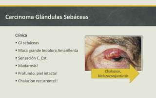 Clínica
 Gl sebáceas
 Masa grande Indolora Amarillenta
 Sensación C. Ext.
 Madarosis!
 Profundo, piel intacta!
 Chalazion recurrente!!
Carcinoma Glándulas Sebáceas
Chalazion,
Blefaroconjuntivitis
 