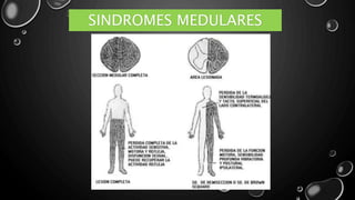 SINDROMES MEDULARES
 