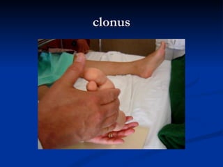 Left Clonus Sindromes Neurologicos | PPT