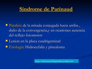 Sindrome de Parinaud <ul><li>Paralisis  de la mirada conjugada hacia arriba , daño de la convergencia,y en ocasiones ausen...
