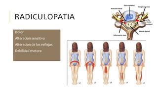 RADICULOPATIA
Dolor
Alteracion sensitiva
Alteracion de los reflejos
Debilidad motora
 