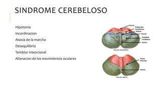 SINDROME CEREBELOSO
Hipotonia
Incordinacion
Ataxia de la marcha
Desequilibrio
Temblor intencional
Alteracion de los movimientos oculares
 