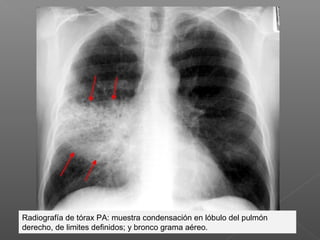 Radiografía de tórax PA: muestra condensación en lóbulo del pulmón
derecho, de limites definidos; y bronco grama aéreo.
 