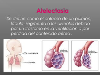 Se define como el colapso de un pulmón,
lóbulo ,segmento o los alveolos debido
por un trastorno en la ventilación o por
perdida del contenido aéreo .
 