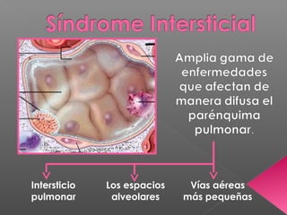 Intersticio
pulmonar
Los espacios
alveolares
Vías aéreas
más pequeñas
 