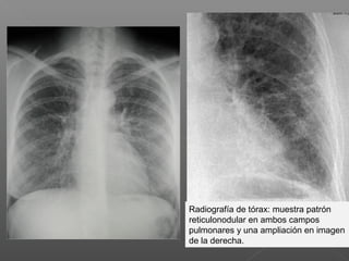 Radiografía de tórax: muestra patrón
reticulonodular en ambos campos
pulmonares y una ampliación en imagen
de la derecha.
 