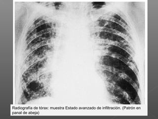 Radiografía de tórax: muestra Estado avanzado de infiltración. (Patrón en
panal de abeja)
 
