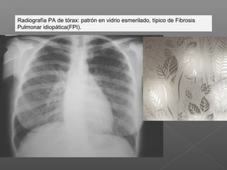 Radiografía PA de tórax: patrón en vidrio esmerilado, típico de Fibrosis
Pulmonar idiopática(FPI).
 