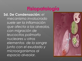 Sd. De Condensación: el
mecanismo involucrado
suele ser la inflamación
que afecta a los alveolos,
con migración de
leucocitos polimorfo
nucleares u otros
elementos de la sangre
junto con el exudado y
microorganismos al
espacio alveolar.
 
