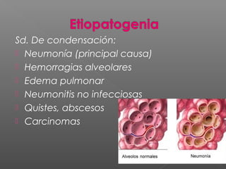 Sd. De condensación:
 Neumonía (principal causa)
 Hemorragias alveolares
 Edema pulmonar
 Neumonitis no infecciosas
 Quistes, abscesos
 Carcinomas
 