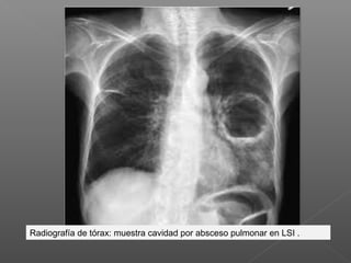 Radiografía de tórax: muestra cavidad por absceso pulmonar en LSI .
 