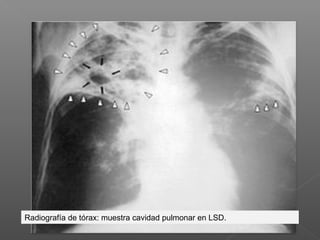 Radiografía de tórax: muestra cavidad pulmonar en LSD.
 