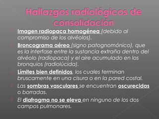  Imagen radiopaca homogénea (debido al
compromiso de los alvéolos).
 Broncograma aéreo (signo patognomónico), que
es la interfase entre la sustancia extraña dentro del
alvéolo (radiopaca) y el aire acumulado en los
bronquios (radiolúcida).
 Límites bien definidos, los cuales terminan
bruscamente en una cisura o en la pared costal.
 Las sombras vasculares se encuentran oscurecidas
o borradas.
 El diafragma no se eleva en ninguno de los dos
campos pulmonares.
 